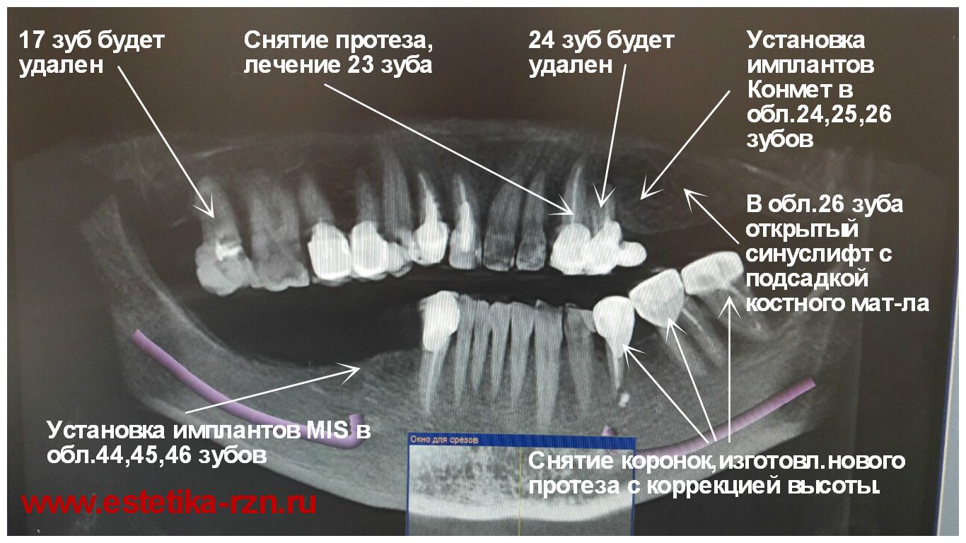 норма лунки после удаления зуба фото