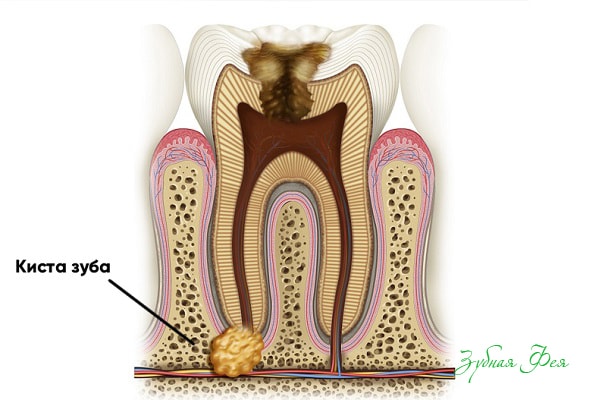киста зуба