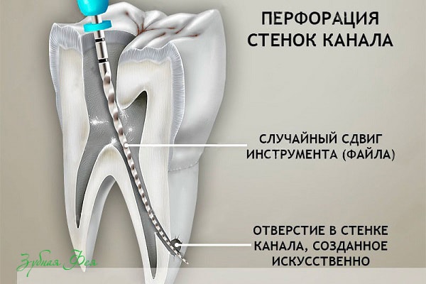 перфорация стенок канала зуба