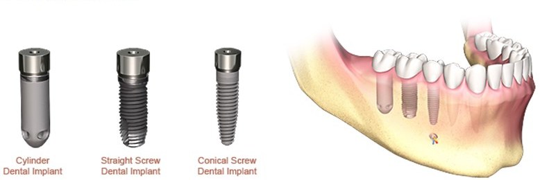 implanturi si tipui de lucrari de forma radacinii
