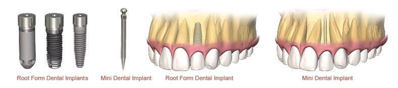 miniimplanturi dentare, implanturi si tipuri de lucrari