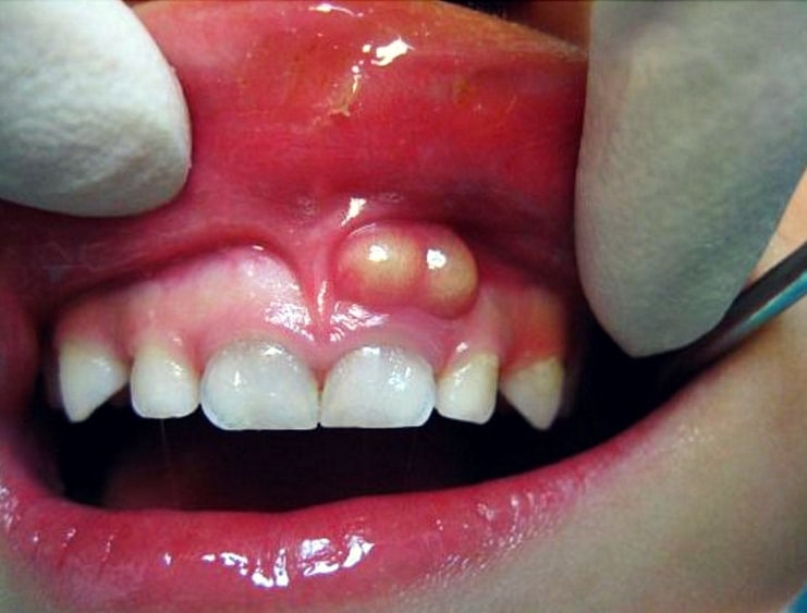 abscessed tooth