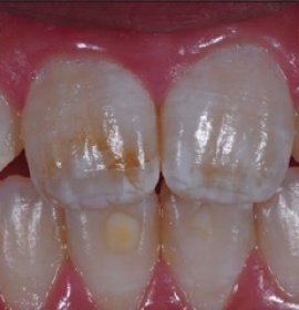 ICON: Caries Treatment without Drilling 