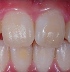 ICON: Caries Treatment without Drilling 
