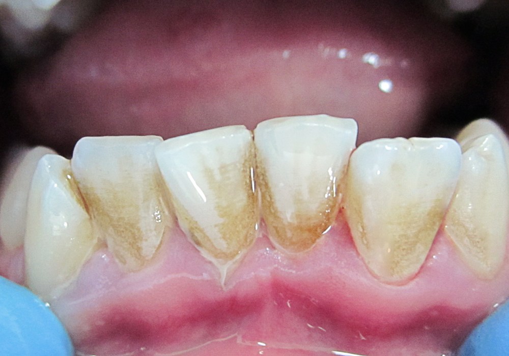 Очаговая деминерализация зубов, потемнение