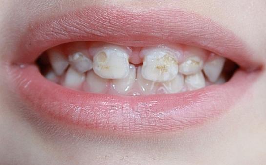 Деминерализация эмали зубов у детей