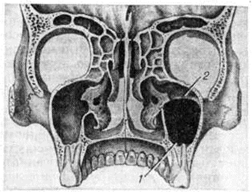 Левая верхнечелюстная пазуха. Соустье гайморовой пазухи анатомия. Устье гайморовой пазухи. Искусственное соустье гайморовой пазухи. Пневматический Тип верхнечелюстной пазухи.