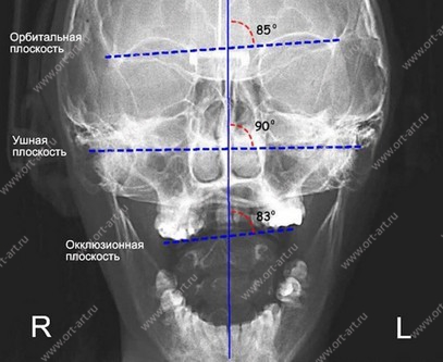 Рентген деформаций, приводящих к асимметрии лица