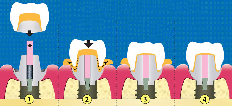 поэтаптаная схема при имплантации зубов