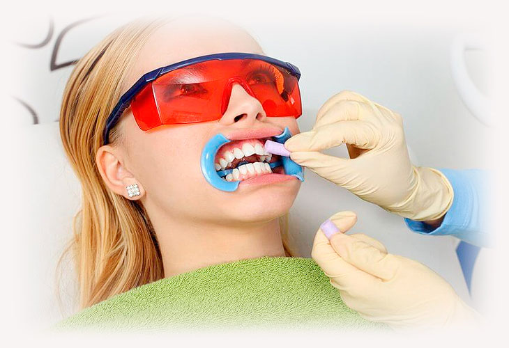 Как проводится отбеливание зубов