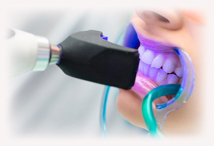 Проведение отбеливания зубов в стоматологической клинике