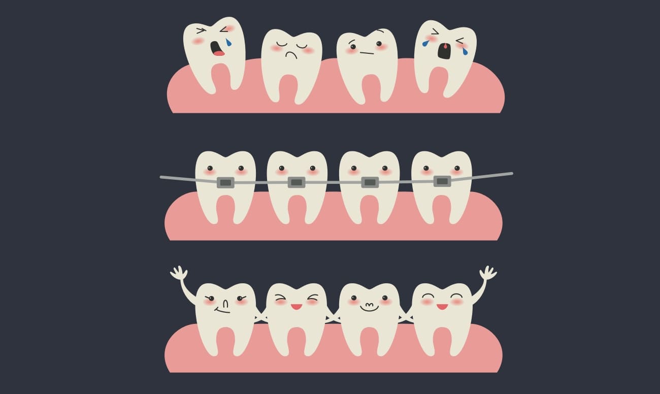 Этапы выравнивания зубов брекетами у детей в картинках