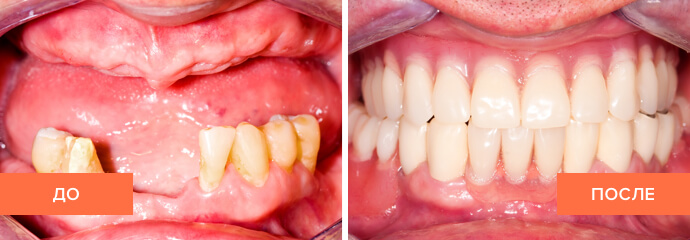 Фото зубных протезов до и после установки