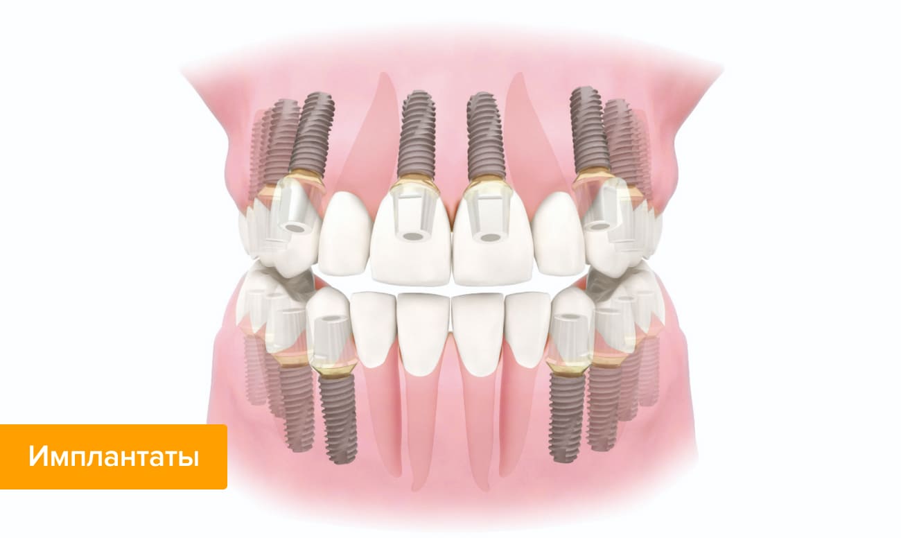 Фото установленных зубных имплантатов