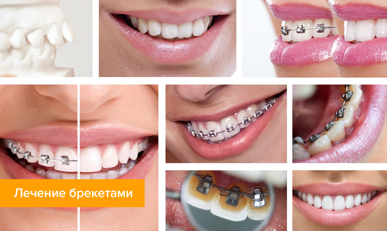 Фото зубов до и после лечения брекетами 
