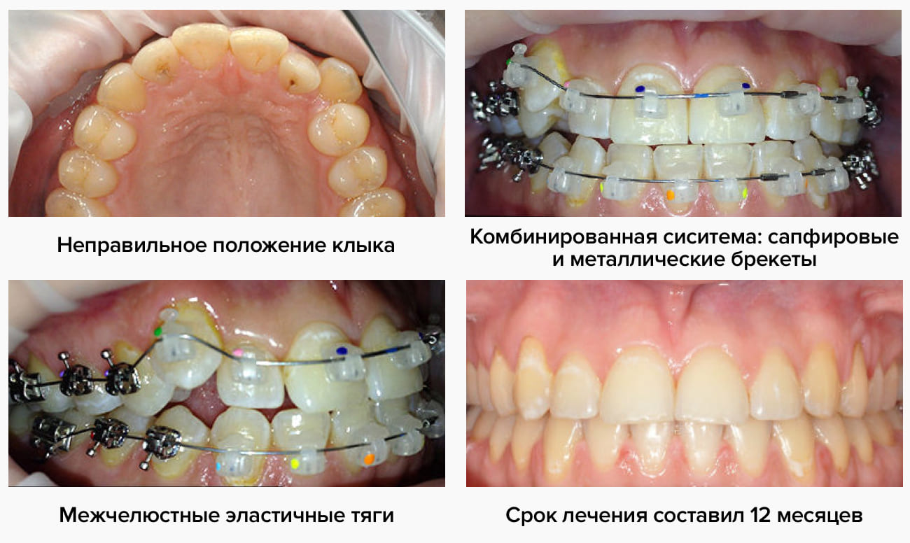Фото на разных этапах лечения безлигатурными брекетами