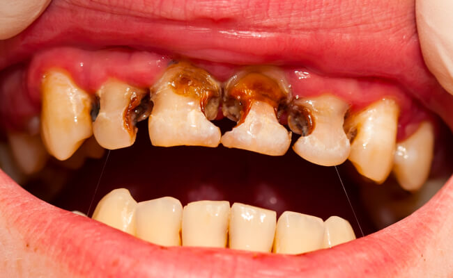 Фото пациента с атипичным кариесом передних зубов IV класса по Блэку.