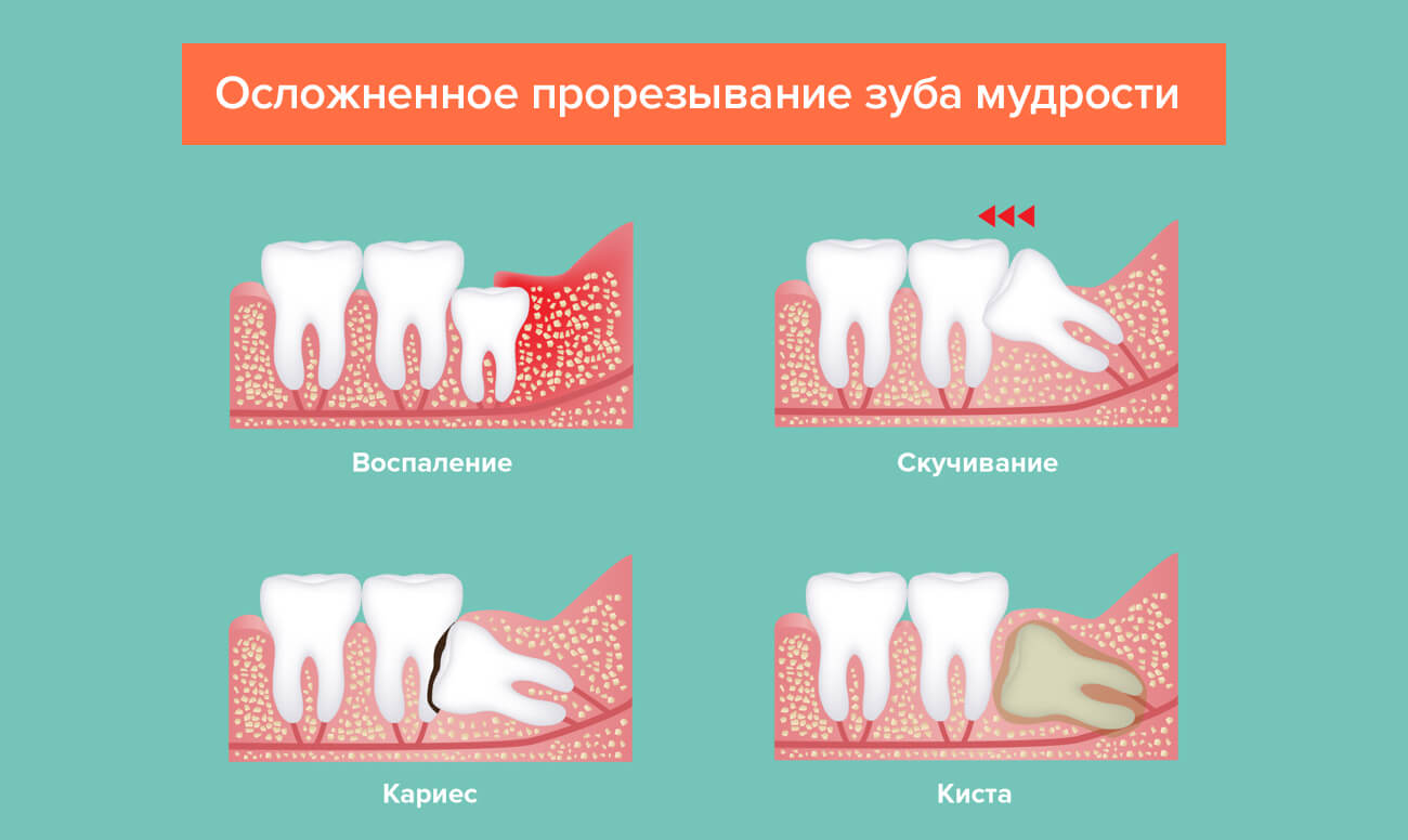 Различные заболевания, требующие удаления или лечения зуба мудрости.
