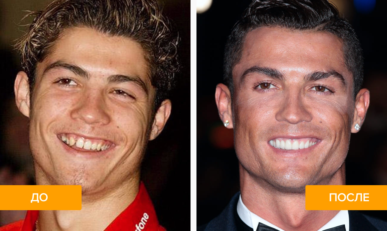 Фото кривых зубов Криштиану Роналду до и после лечения