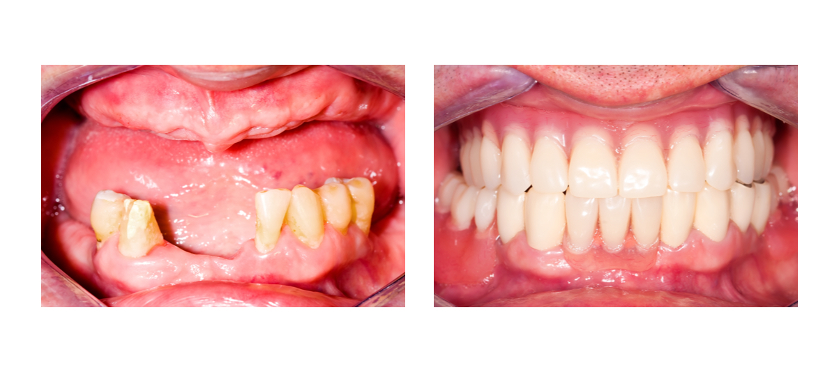 Фото пациента до и после протезирования зубов