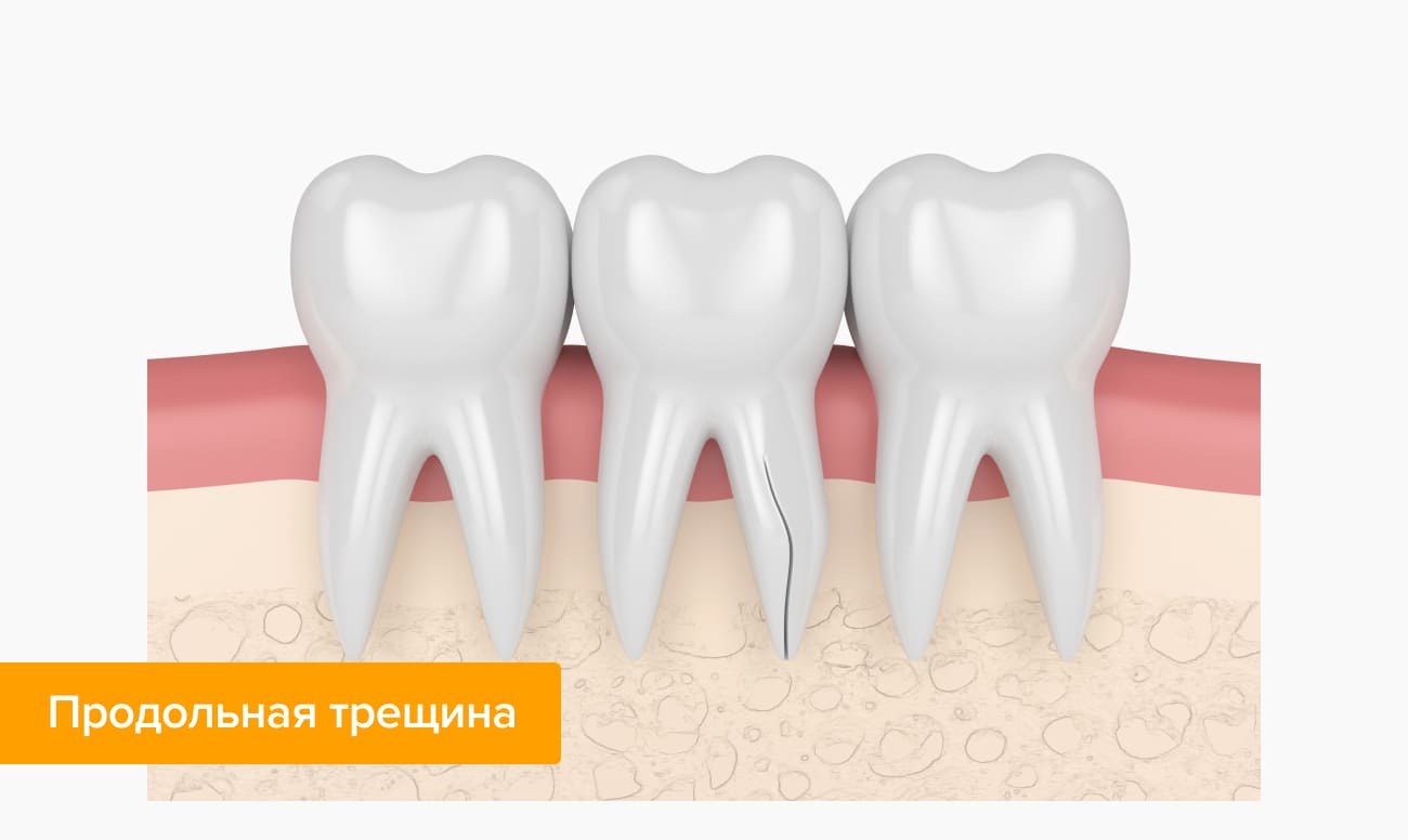 Продольная трещина Продольная трещина в картинках