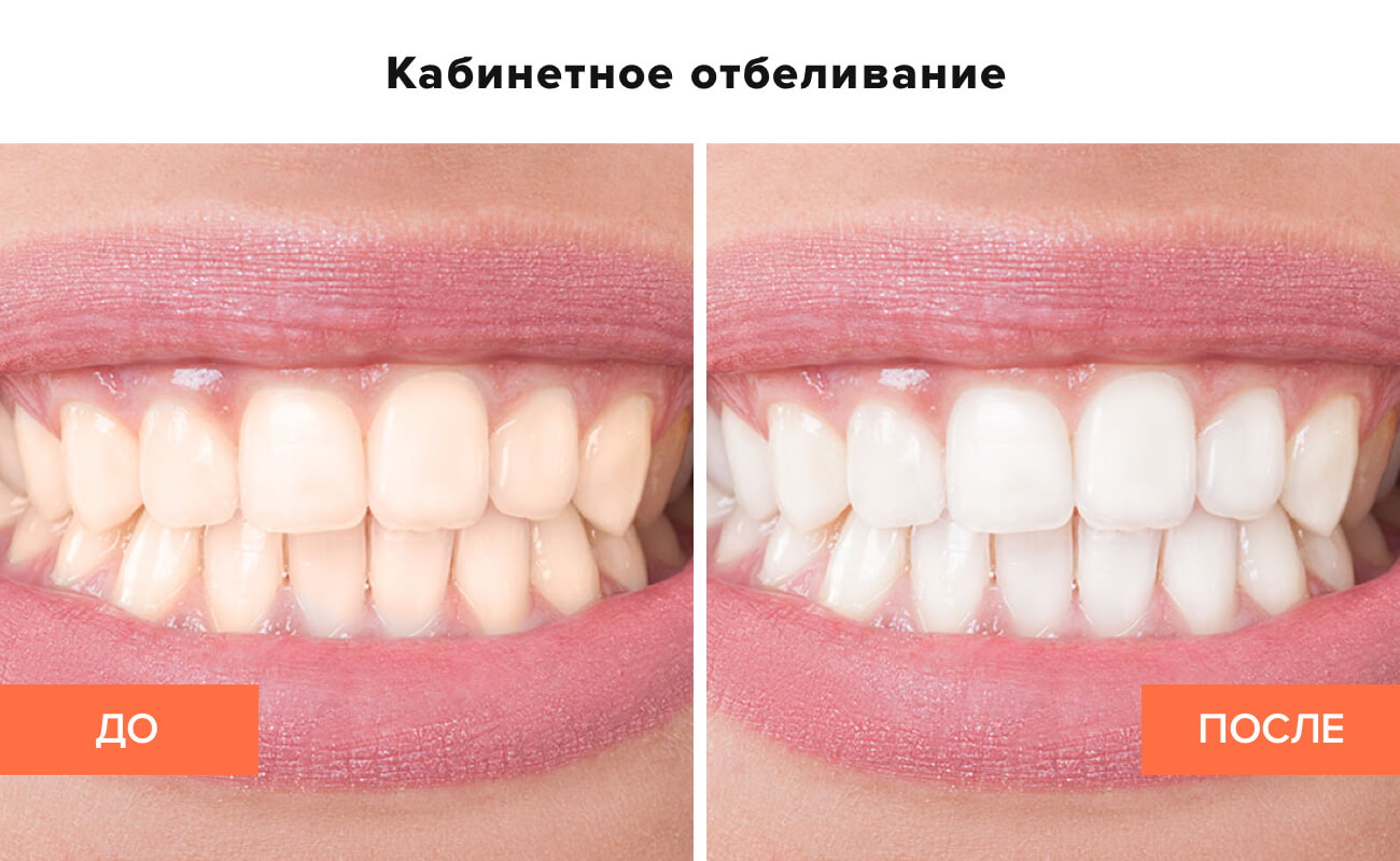 Лазерное отбеливание отзывы. Отбеливание зубов до и после. Профессиональное отбеливание зубов до и после. Зубы до и после фотоотбеливания. Отбеливание зубов кабинетное до и после.