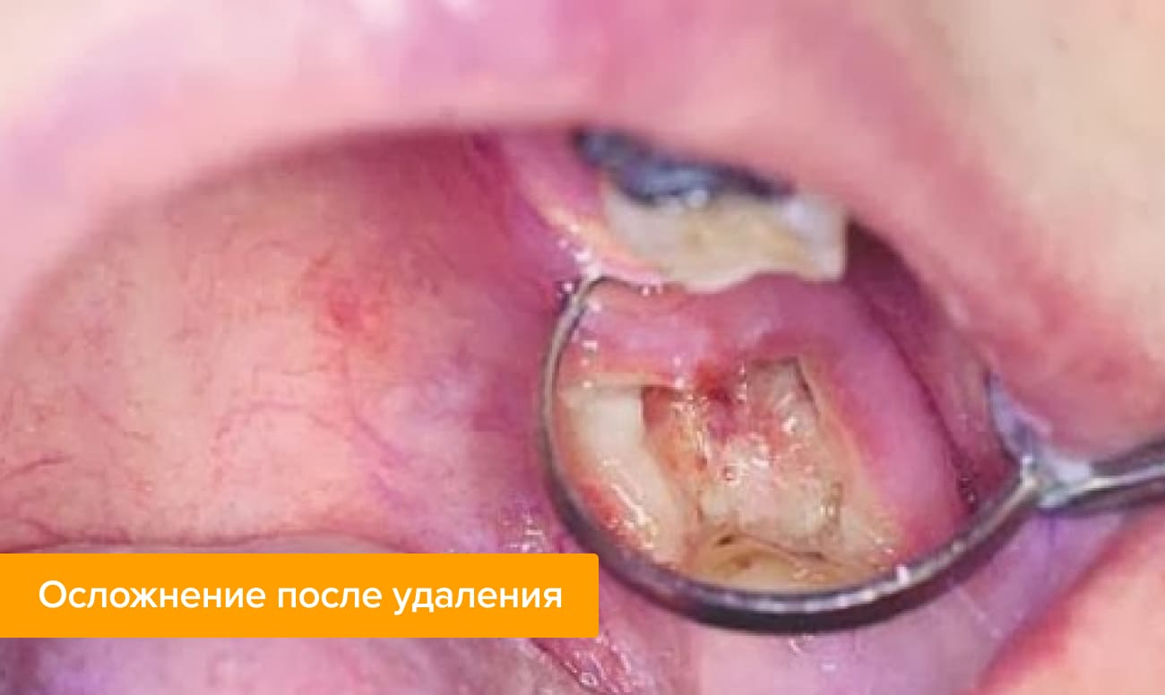 Фото осложнения в виде гноя в лунке после удаления зуба