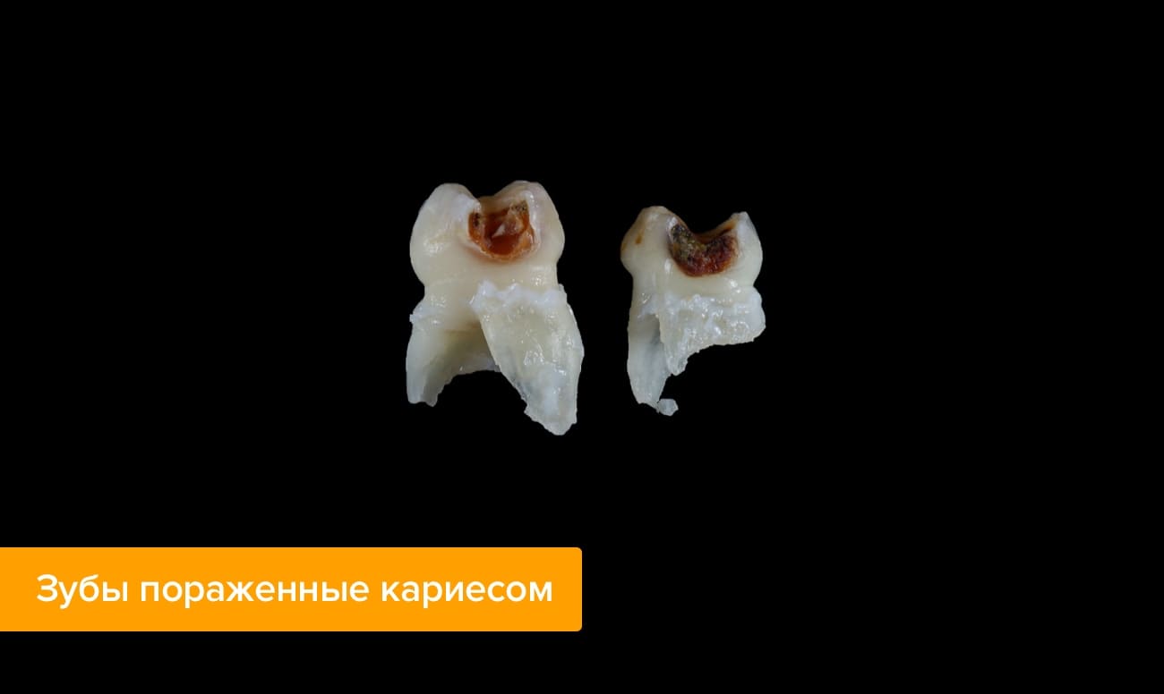 Фото зубов пораженных кариесом