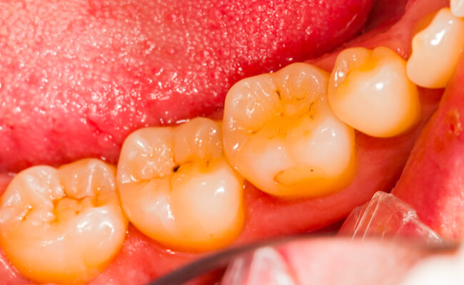 Фото пациента с кариесом эмали на жевательных зубах.