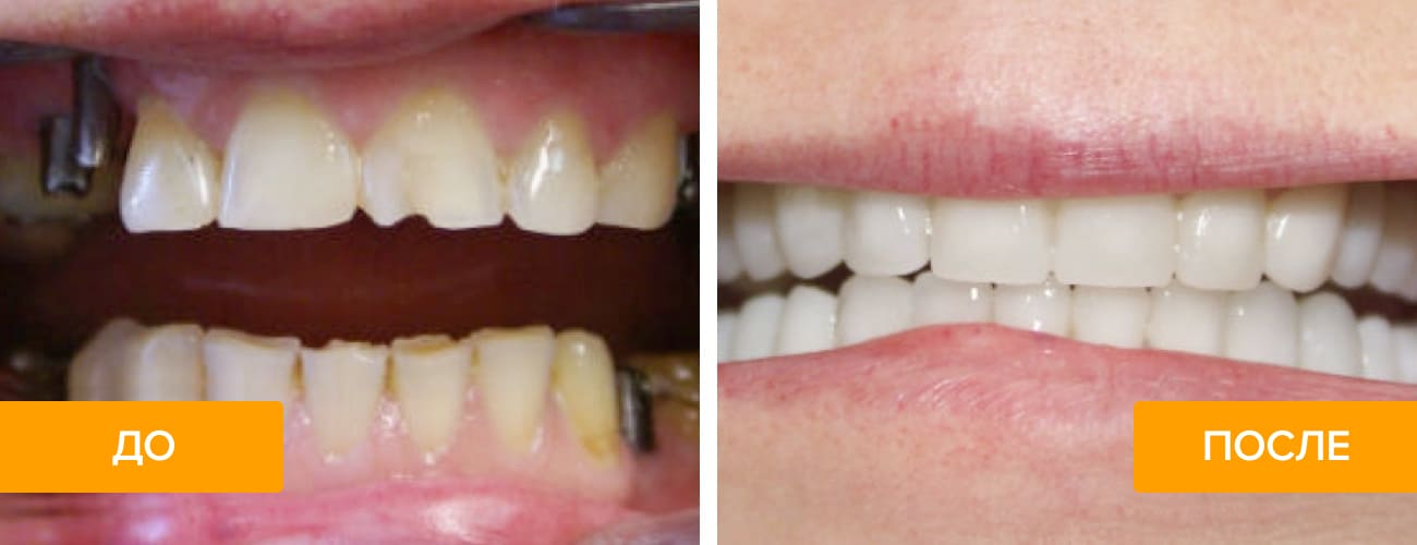 Фото пациента до и после протезирования зубов