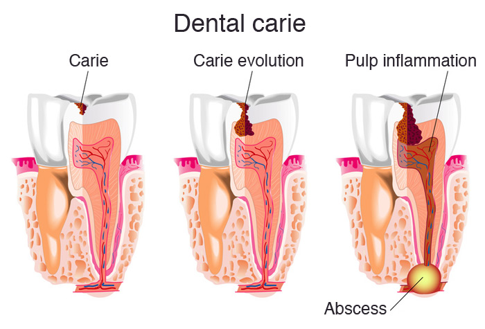 Evolution of dental caries