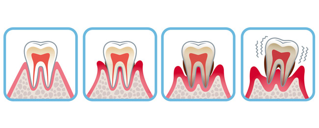 Evolution gum disease