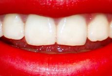 отбелить зубы в стоматологии