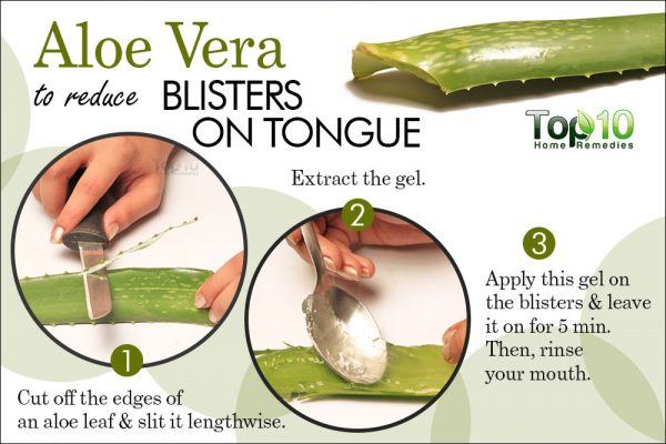 aloe vera remedy for blisters on tongue