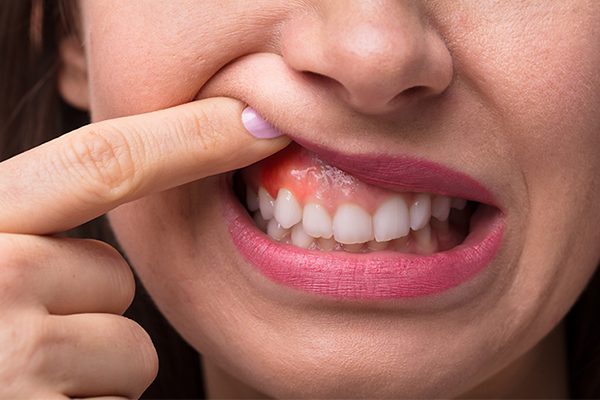 Home remedies to reduce gum swelling 