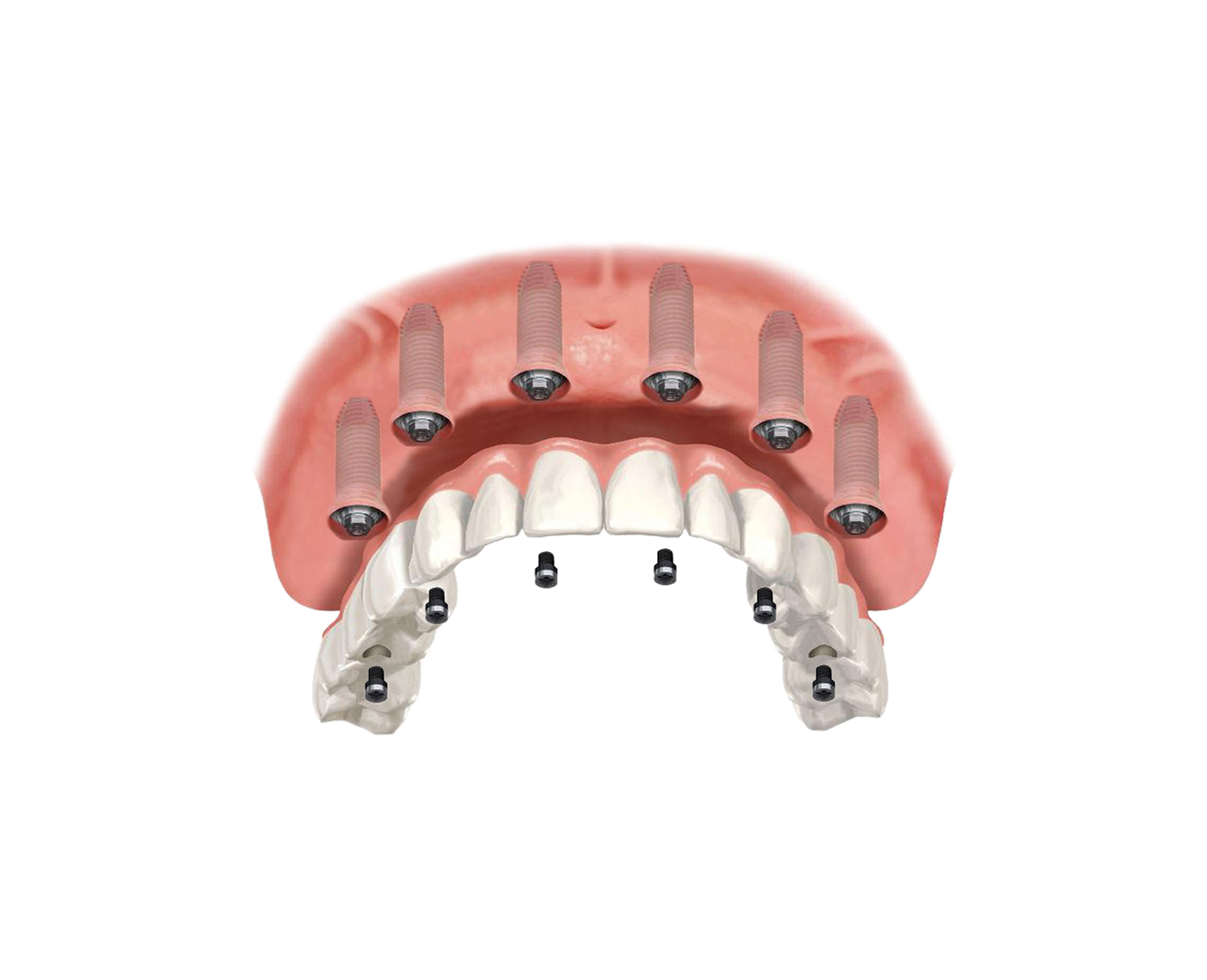 Имплантация зубов all on 6. А23.07. 002.040 Полный съемный протез. Несъёмный мостовидный протез челюсти. Имплантация челюсти на 6 имплантах.
