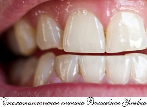 Реставрация зубов стекловолокном – эстетичная функциональность