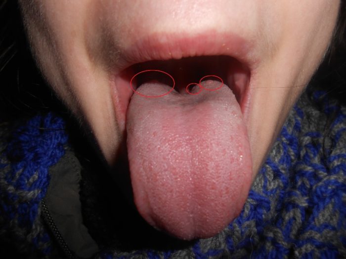 Воспаление корня языка, причины и методы лечения