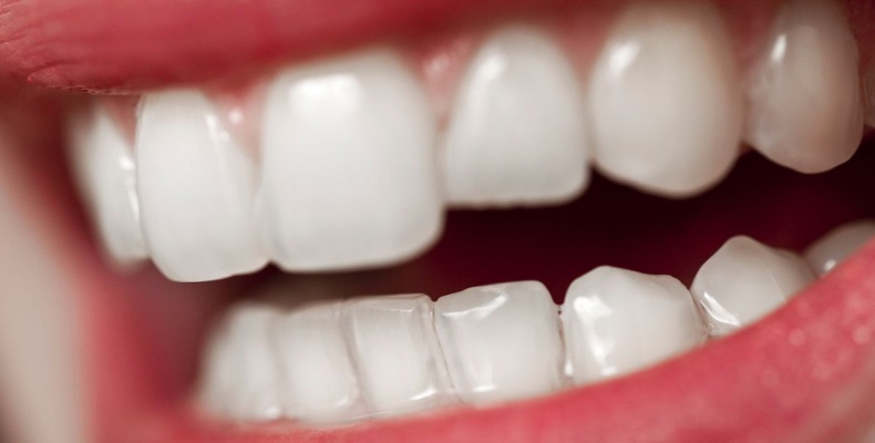 Можно ли отбеливать зубы с пломбами