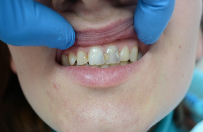 По каким причинам зуб реагирует на холодное после пломбирования?