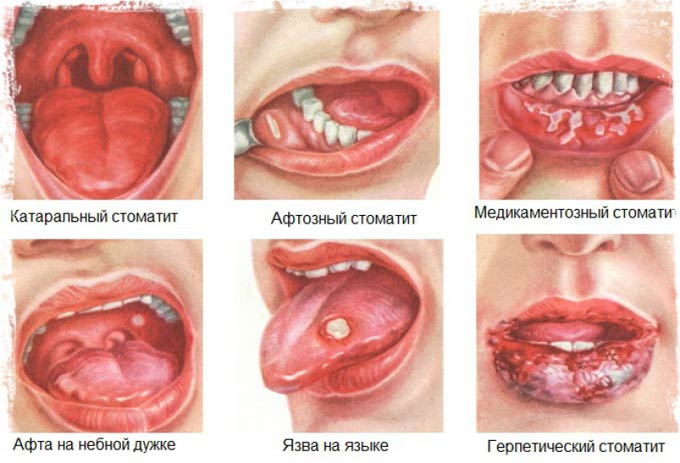 виды стоматита