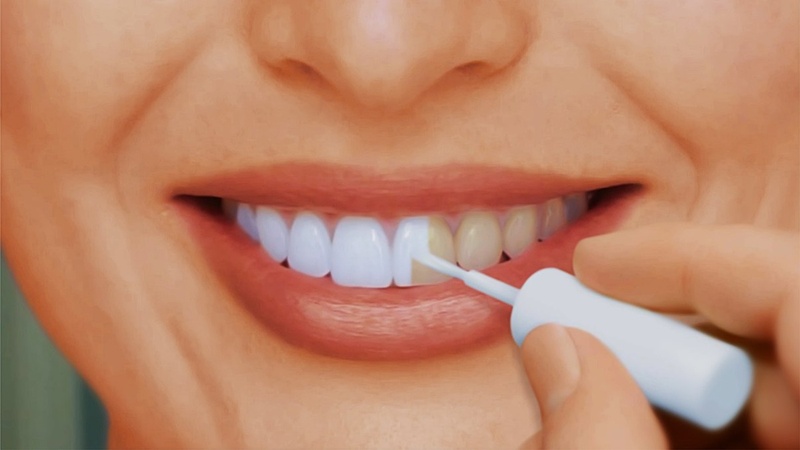 Можно ли отбеливать зубы с пломбами