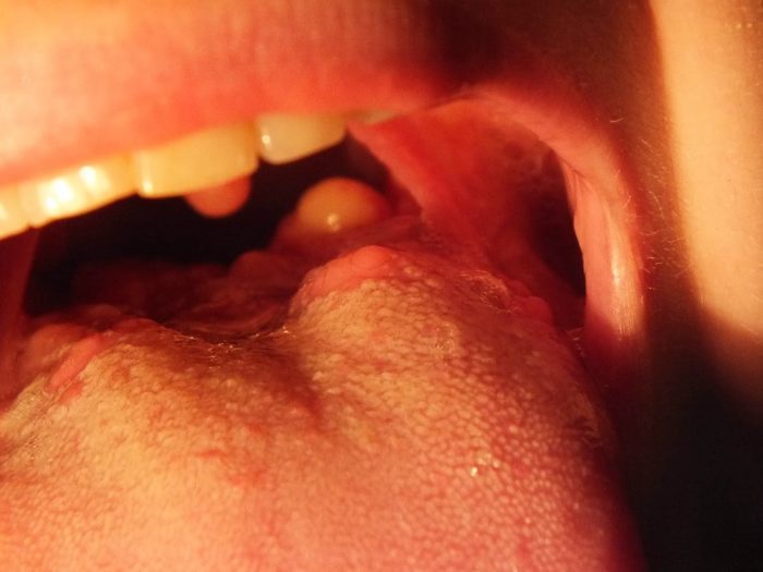 Воспаление корня языка, причины и методы лечения