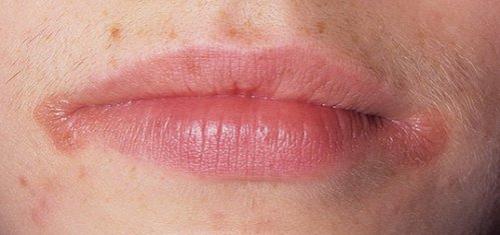 Трещины в уголках рта: лечение мазь. 11 причин трещин в уголках рта и их лечение