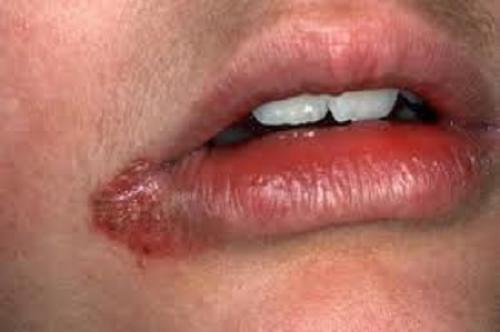 Трещины в уголках рта: лечение мазь. 11 причин трещин в уголках рта и их лечение