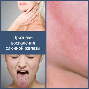 Метод лечения воспаления слюнной железы
