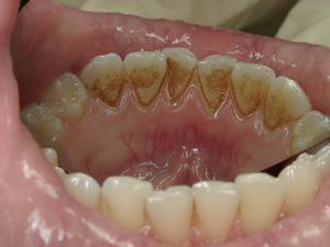 Симптомы образования зубного камня 