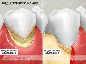 Вид зубного камня 