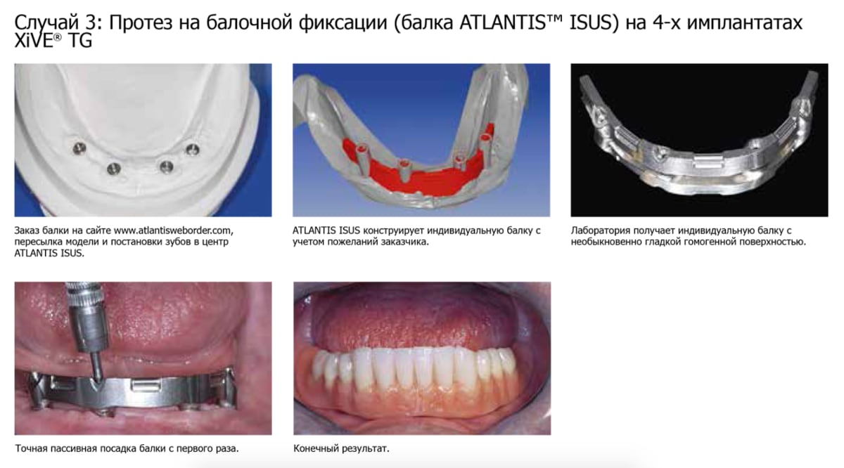 Имплантация sup aznona com. Имплант системы XIVE. Зубной имплант XIVE. Балочный протез на имплантах. Протез на балочной фиксации.