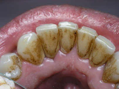 Зубной камень - причина жжения языка